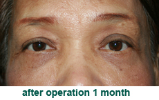 plastic-surgery-blepharoplasty